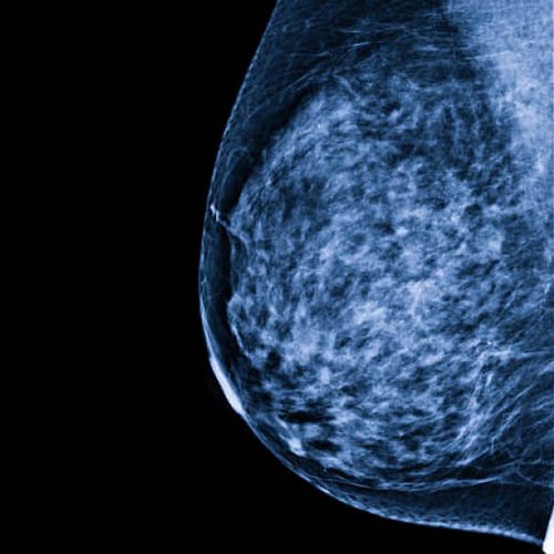 Mammography